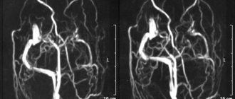 Diagram of cerebral circulation on MRI