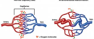 Vascular tumor