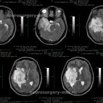 Removal of a large GRADE II WHO astrocytoma of the right temporal lobe (before surgery)