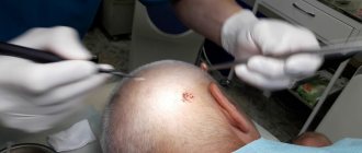 removal of papilloma on the head