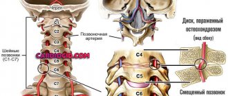 vertebrobasilar insufficiency