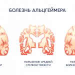 type of alzheimer&#39;s disease