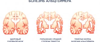 type of alzheimer&#39;s disease