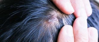 Types and causes of hair bumps on the head