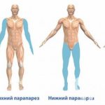 Types of paresis