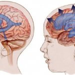 Intracranial pressure