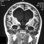 Hydrocele of the brain on MRI