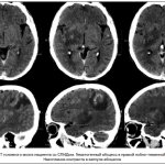 Return of neuroinfections to the clinic