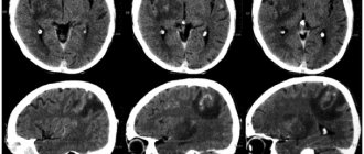 Return of neuroinfections to the clinic